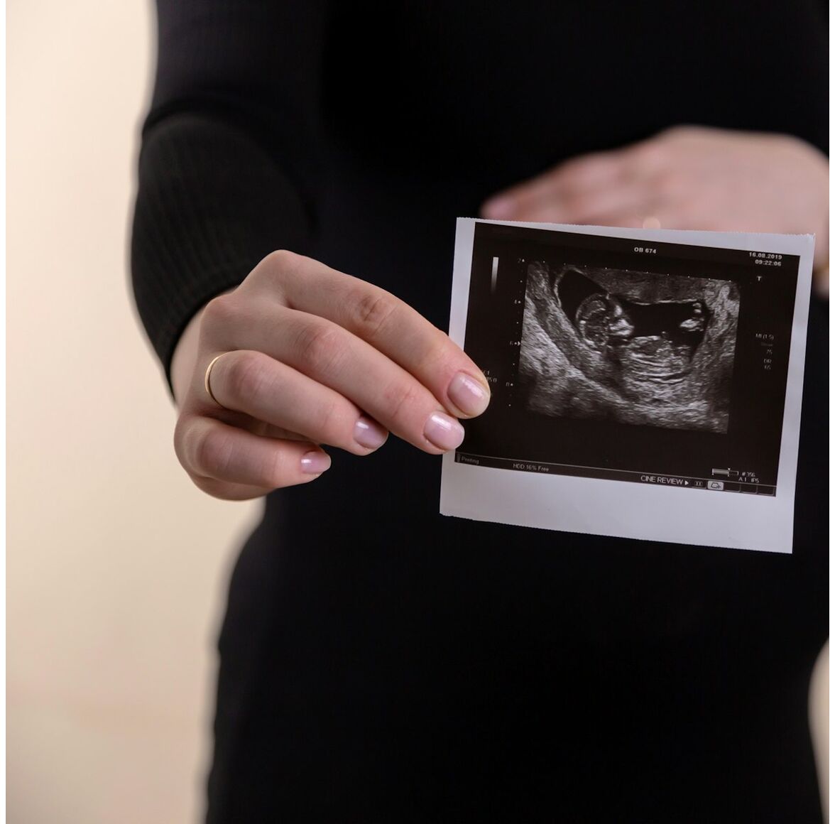 Fetal-DNA КАРИОТИП ПЛЮС
